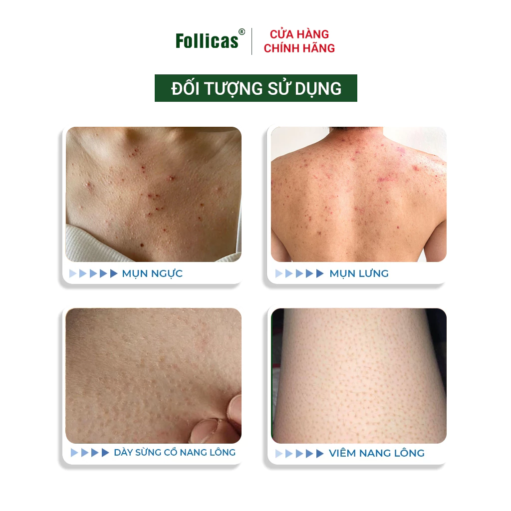 Kem Bôi Viêm Nang Lông Follicas Cream 50g - Ảnh 5