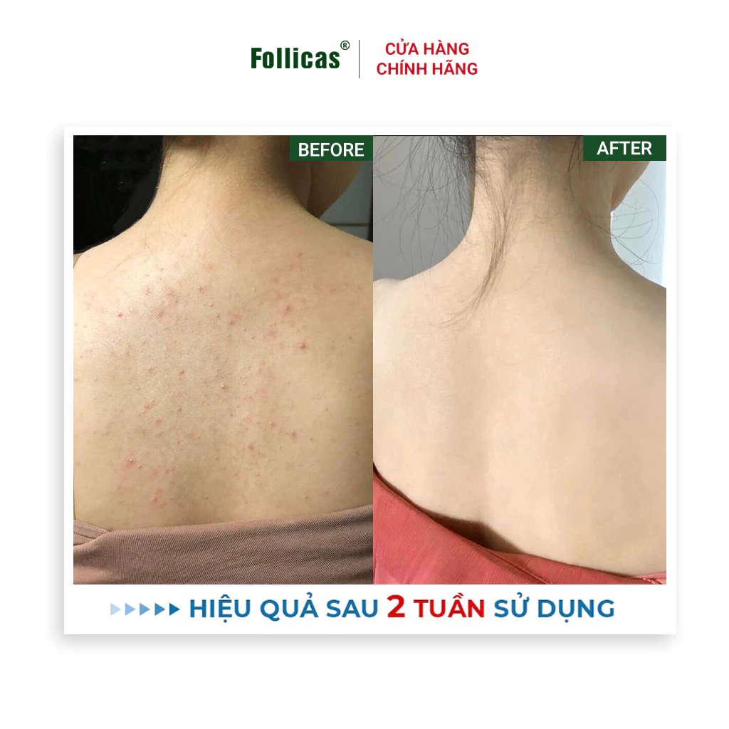 Kem Bôi Viêm Nang Lông Follicas Cream 50g - Ảnh 6